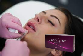 2 * 1ml Juvederm Ultra 3 リップフィラー ヒアルロン酸ゲルフィラー