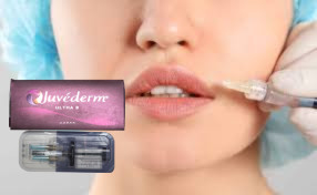 2 * 1ml Juvederm Ultra 3 リップフィラー ヒアルロン酸ゲルフィラー