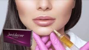 Juvederm Ultra 3 ヒアルロン酸 HA 皮膚充填剤 2ml 唇増強剤