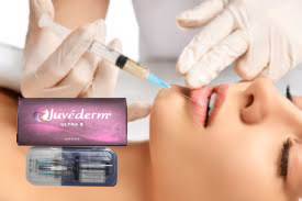CE リップヒアルロン酸 注射用皮膚充填剤 Juvederm Ultra 3 Ultra 4 ボリューム