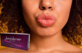 Juvederm Ultra 3 ヒアルロン酸 HA 皮膚充填剤 2ml 唇増強剤