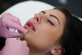 GMP Juvederm Ultra 3 HA 唇用皮膚充填剤 Juvederm フルネージュ