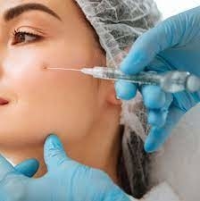 スムーズなしわ 皮膚に注入できるヒアルロン酸 ユベダーム ウルトラ 3 2*1ml